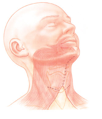 Double Chin Liposuction image 1