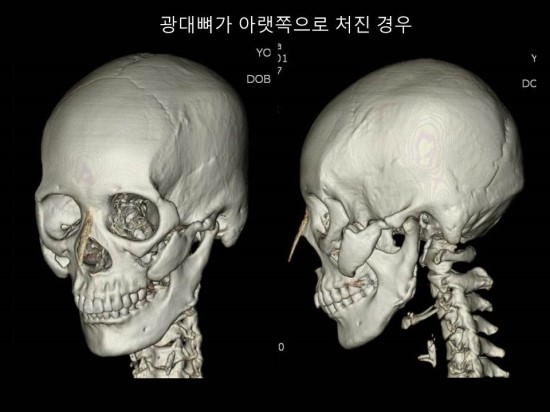 옆광대 축소를 위한 효과적인 방법 관련 이미지 4