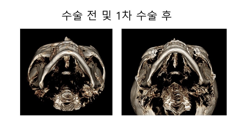 광대뼈 축소성형술 - 수술방법에 따른 모습변화의 차이 관련 이미지 7