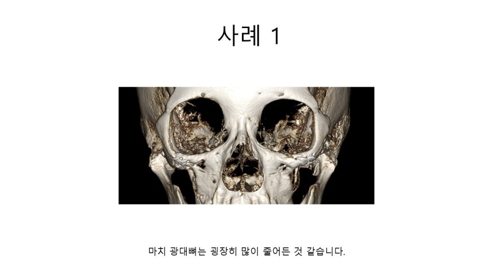 A Zygomatic Surgery Outcome That Makes Anger Surge image 8