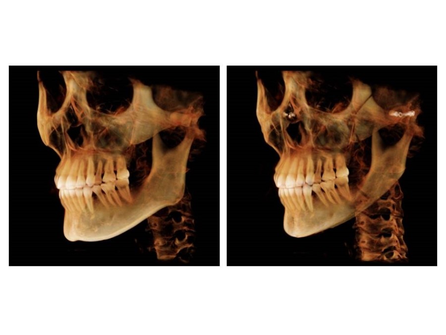 Proper Understanding of Cortical Bone Resection or Cortical Bone Reduction in Square Jaw Surgery image 14