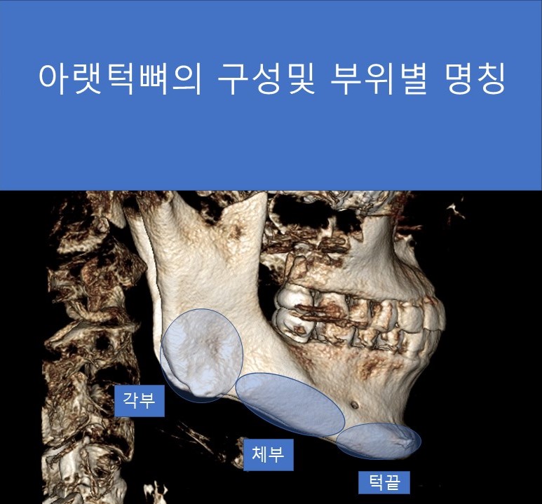 사각턱 수술과 피질골 절제에 관한 심층적 고찰 관련 이미지 2