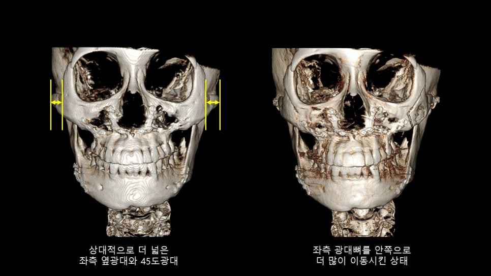광대뼈축소성형술 증례 리뷰 -1 관련 이미지 10