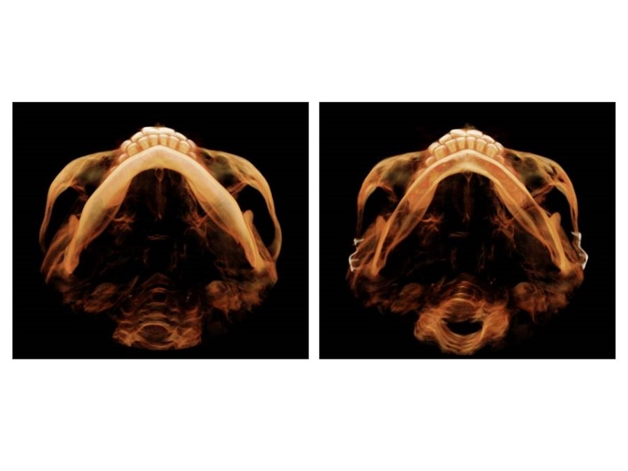 Proper Understanding of Cortical Bone Resection or Cortical Bone Reduction in Square Jaw Surgery image 11