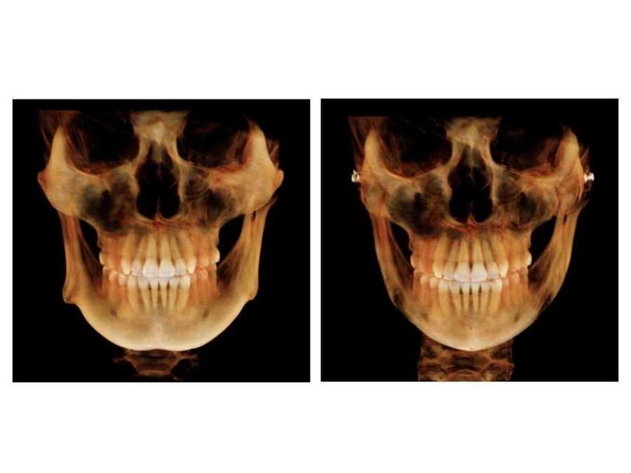 Proper Understanding of Cortical Bone Resection or Cortical Bone Reduction in Square Jaw Surgery image 10