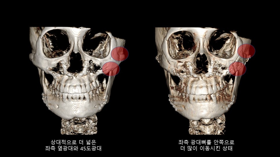 광대뼈축소성형술 증례 리뷰 -1 관련 이미지 11