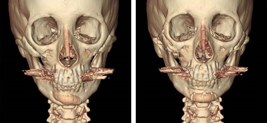 Various Methods of Chin Surgery for Correcting a Recessed Chin and Their Pros and Cons image 9