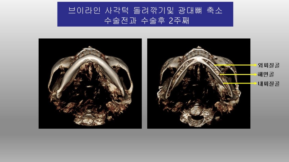 사각턱 수술과 피질골 절제에 관한 심층적 고찰 관련 이미지 4