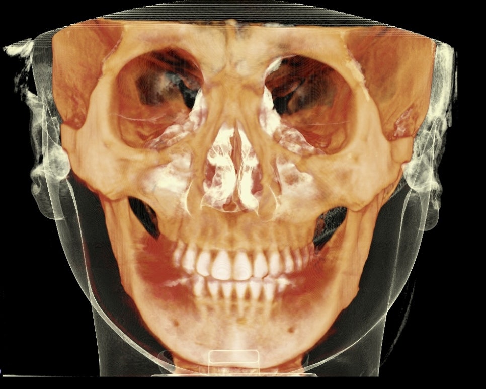 How Is Face Shape Determined? Factors That Determine Face Shape and Facial Contouring Surgery image 2
