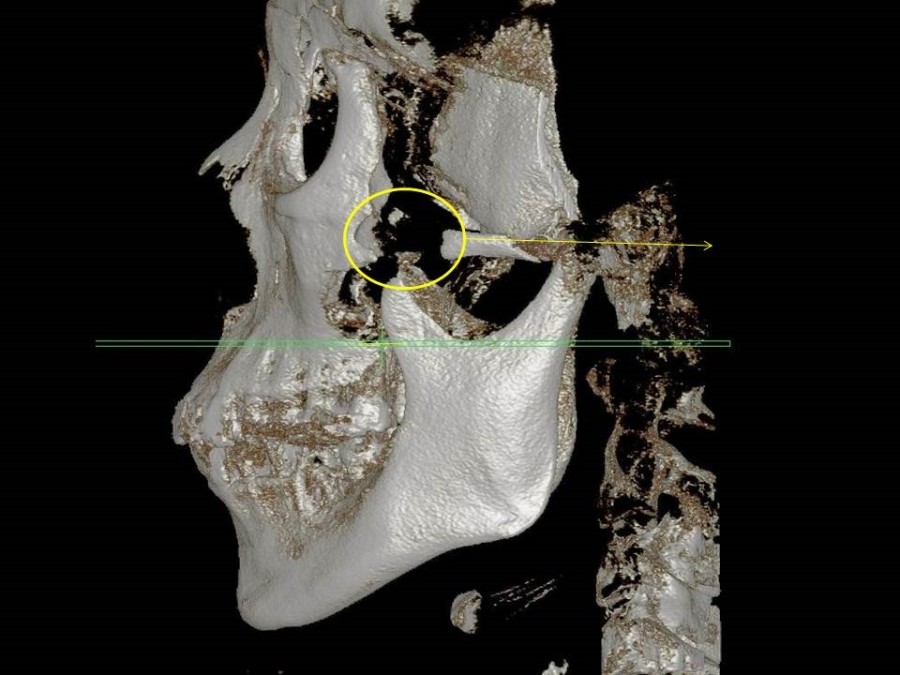 Complication Cases of Zygomatic Reduction Surgery image 2