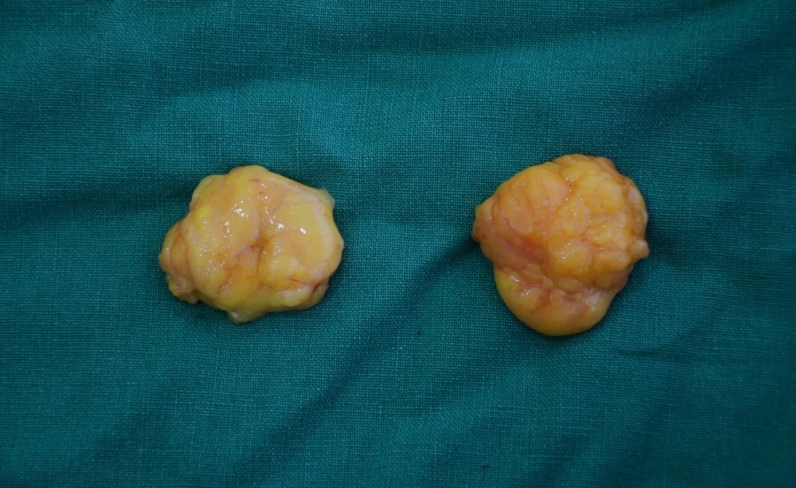 The Amount of Deep Buccal Fat Removed During Deep Buccal Fat Removal image 6