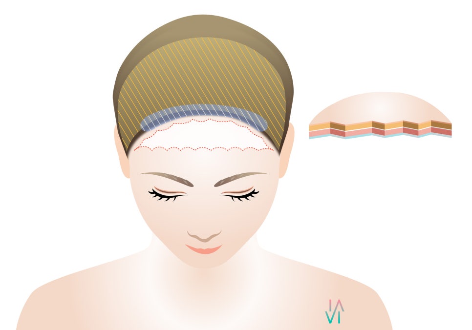 A Proposal to Improve a Broad Forehead - Binary Surgery image 1