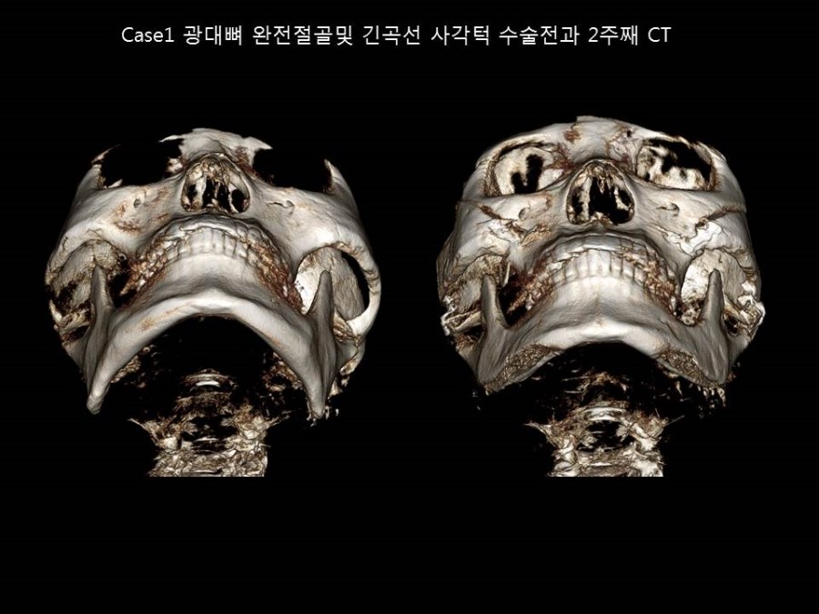 얼굴형에 따른 광대뼈 축소성형술 방법의 적절한 선택 관련 이미지 4
