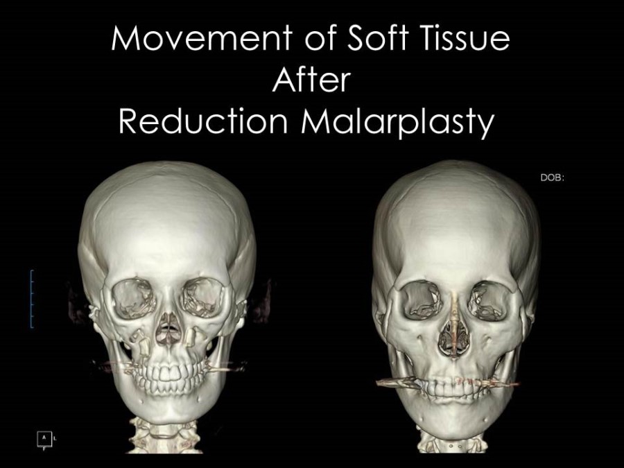 Facial Contouring Surgery and Cheek Sagging image 1