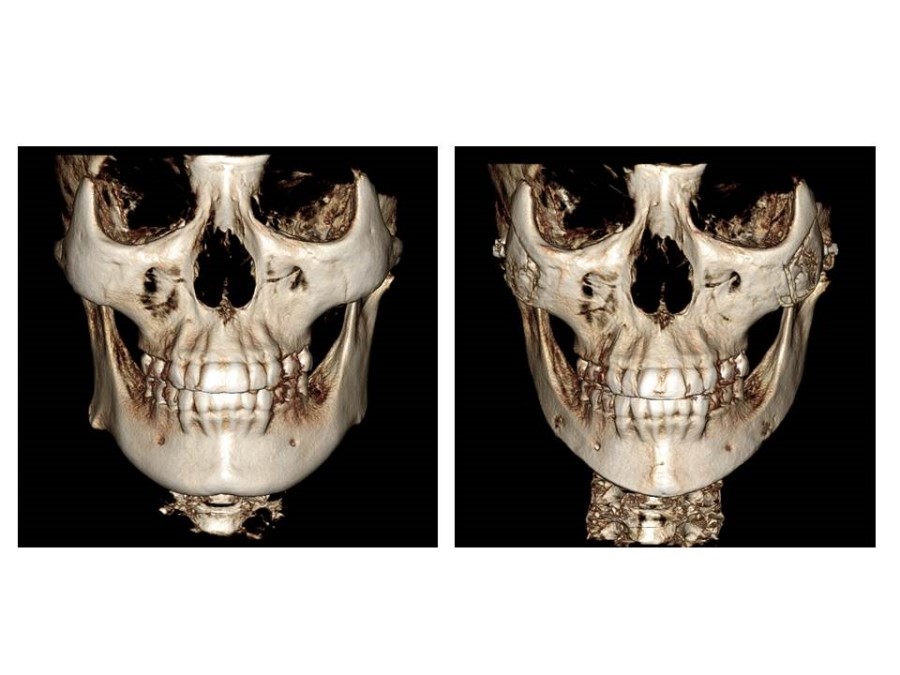 Proper Understanding of Cortical Bone Resection or Cortical Bone Reduction in Square Jaw Surgery image 5