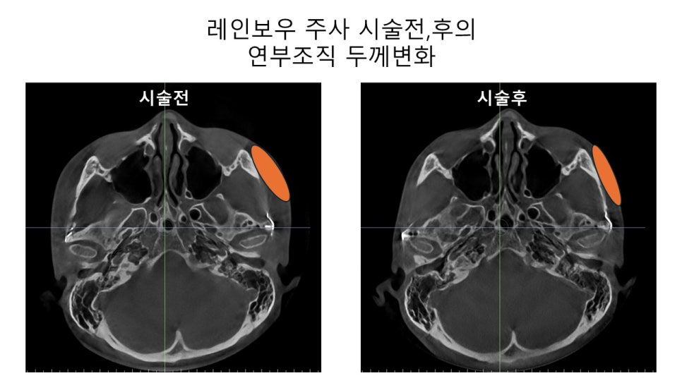 얼굴 윤곽에 있어서 연부조직의 중요성 - 윤곽주사, 레인보우 주사 관련 이미지 11