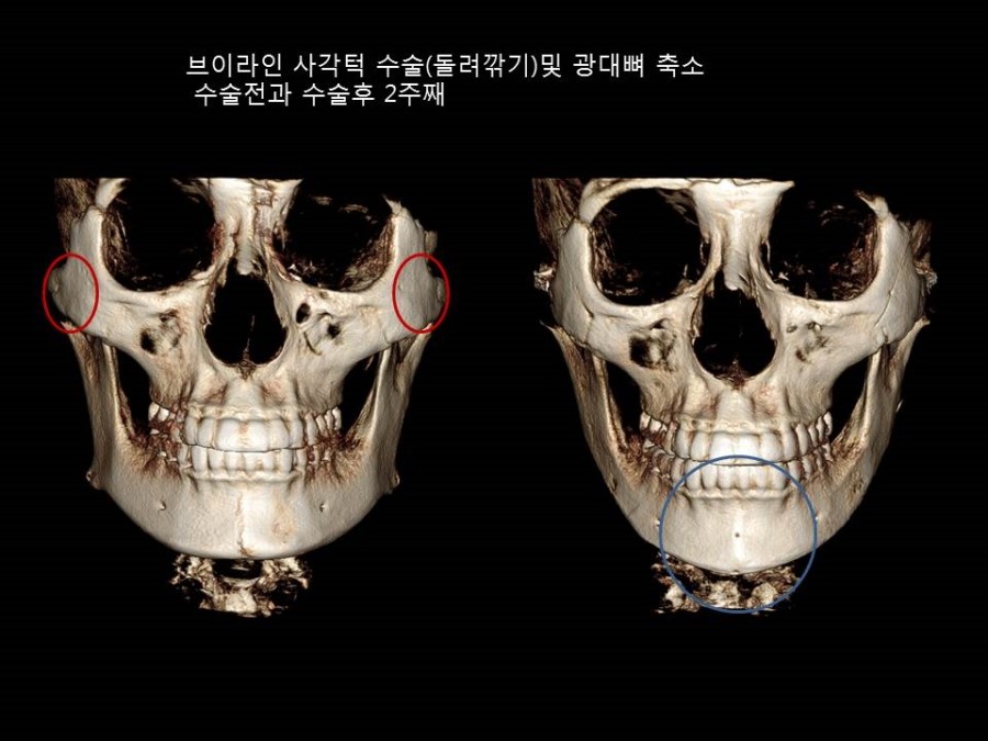 얼굴형에 따른 광대뼈 축소성형술 방법의 적절한 선택 관련 이미지 5