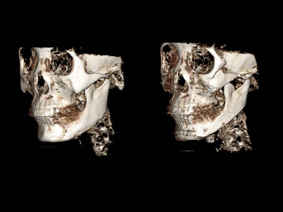Zygoma Reduction Surgery Through Complete Osteotomy of the Body and Arch image 28