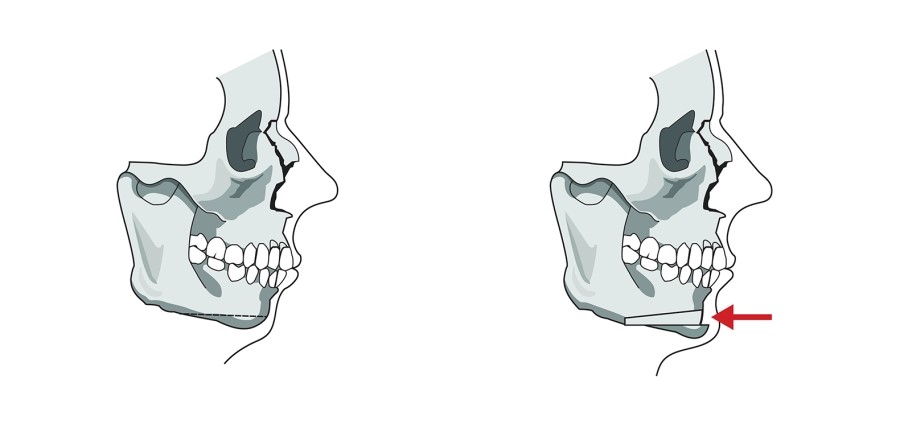 Overall Information About Chin Surgery for a Receded Chin image 4