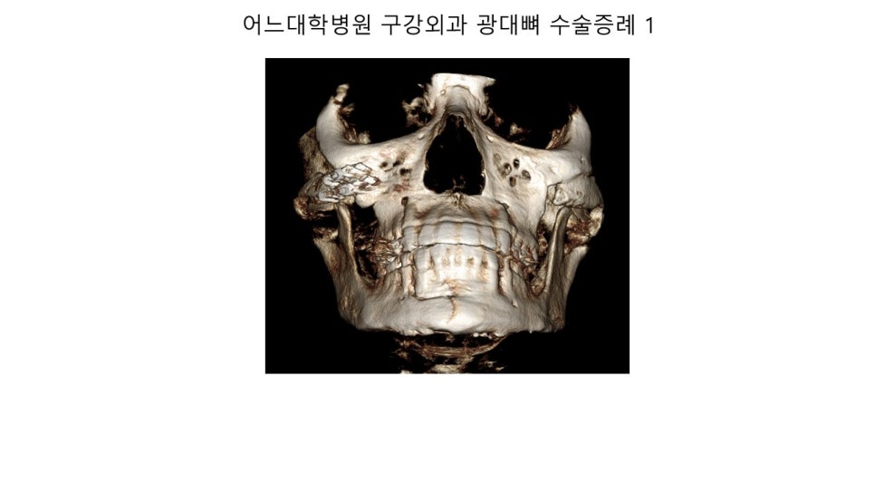 안면윤곽 수술전과 후의 증례 고찰 관련 이미지 15