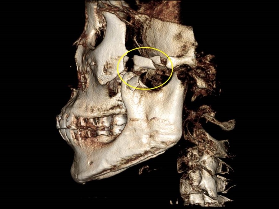 Complication Cases of Zygomatic Reduction Surgery image 5