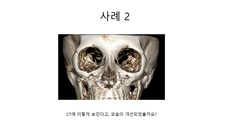 A Zygomatic Surgery Outcome That Makes Anger Surge image 14
