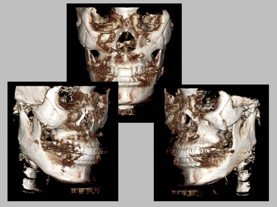 Meticulous Zygomatic Reduction Surgery image 7