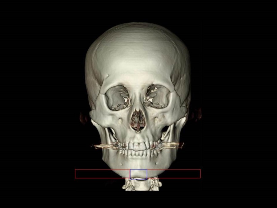 V-Line Square Jaw Surgery - The Truth and Reality of T-Osteotomy image 3