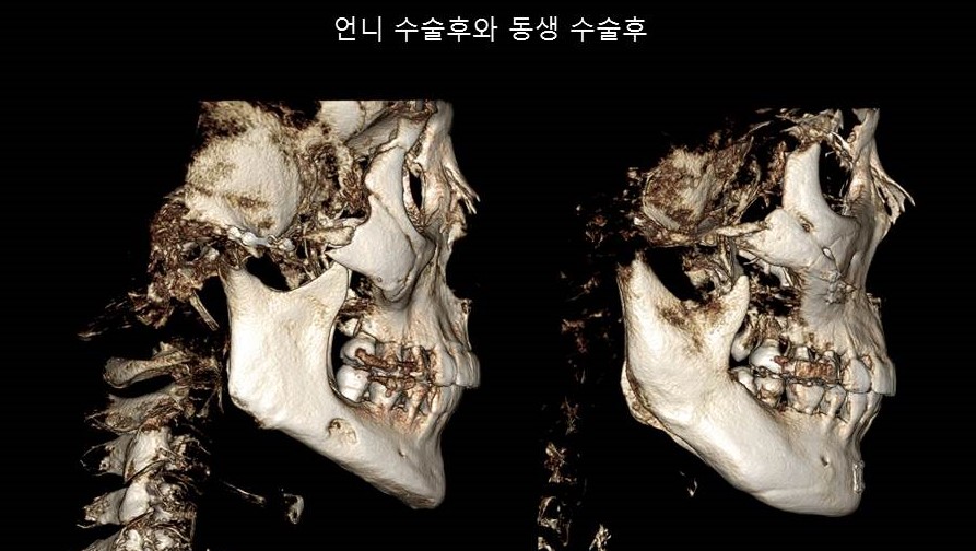 Understanding Square Jaw Surgery - Comparison of Postoperative Results Between Biological Sisters Who Underwent Surgery Using Different Methods image 8
