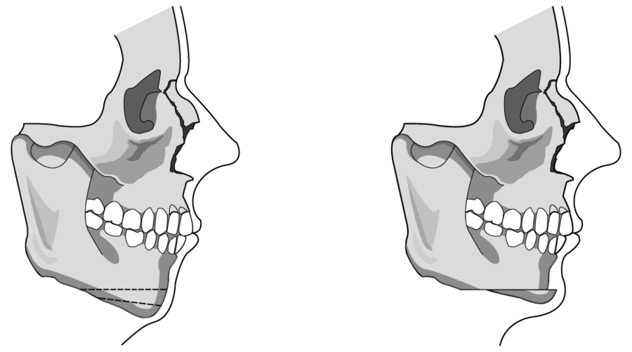 Overall Information About Chin Surgery for a Receded Chin image 5