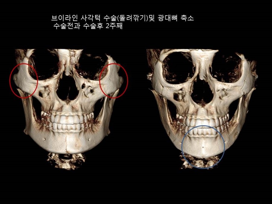 안면윤곽 수술전과 후, 뼈의 모습변화 - 광대뼈축소및 브이라인사각턱(돌려깎기) 관련 이미지 1