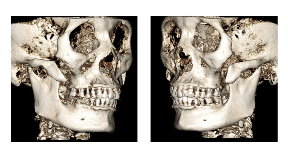 Why Cheekbone Revision Surgery for Sagging Cheeks and Nonunion 30 Years After Cheekbone Surgery Succeeded After a Facelift image 2