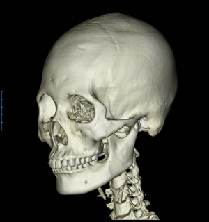 안면골의 삼차원 단층촬영(3D-CT, 3DCT) 란? 관련 이미지 3
