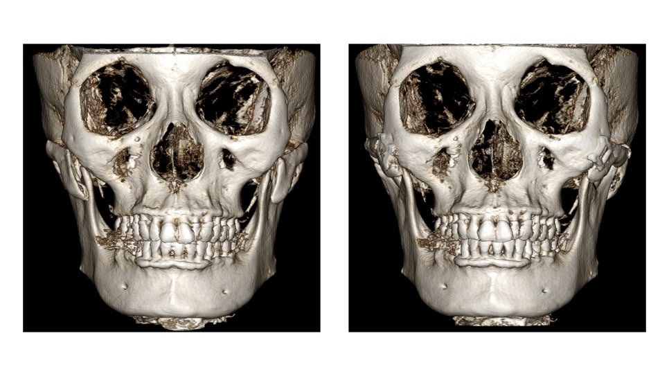 Why Cheekbone Revision Surgery for Sagging Cheeks and Nonunion 30 Years After Cheekbone Surgery Succeeded After a Facelift image 3