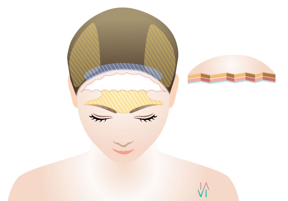 A Proposal to Improve a Broad Forehead - Binary Surgery image 2