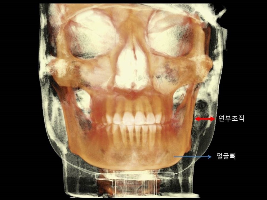3DCT분석을 통한 심부볼지방의 위치와 심부볼지방이 얼굴윤곽에 미치는 영향 관련 이미지 1
