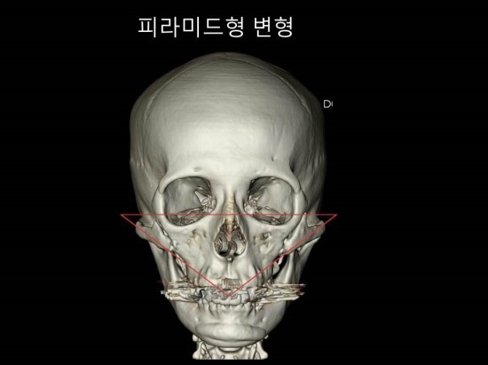 광대뼈축소성형술과 재수술을 생각하는 경우 관련 이미지 2