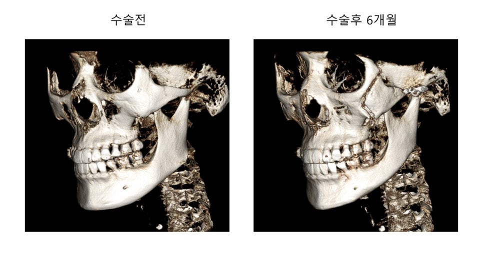 안면윤곽 수술전과 후의 증례 고찰 관련 이미지 5