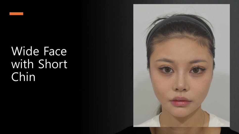 윤곽 3종 수술후 8년...사진으로 보는 사례고찰 관련 이미지 3