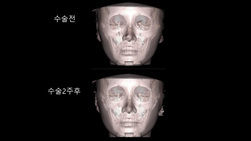 안면윤곽수술후 모습이 바뀌어 보이려면 얼마나 기다려야 할까? "윤곽수술과 술후 다운타임및 술후 관리방법" 관련 이미지 37