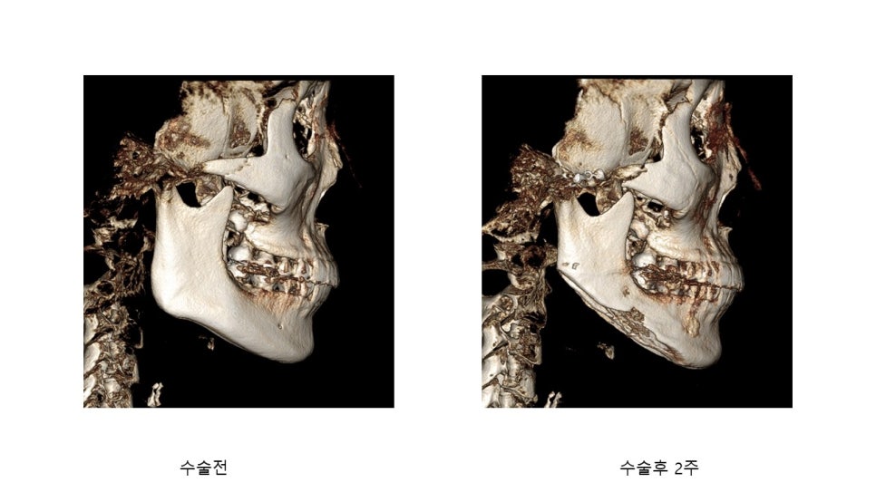 사각턱 수술후 시기에 따른 아랫턱뼈의 형태변화 관련 이미지 28