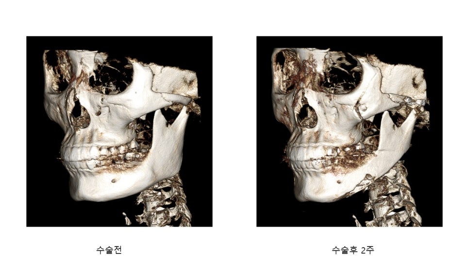 사각턱 수술후 시기에 따른 아랫턱뼈의 형태변화 관련 이미지 22