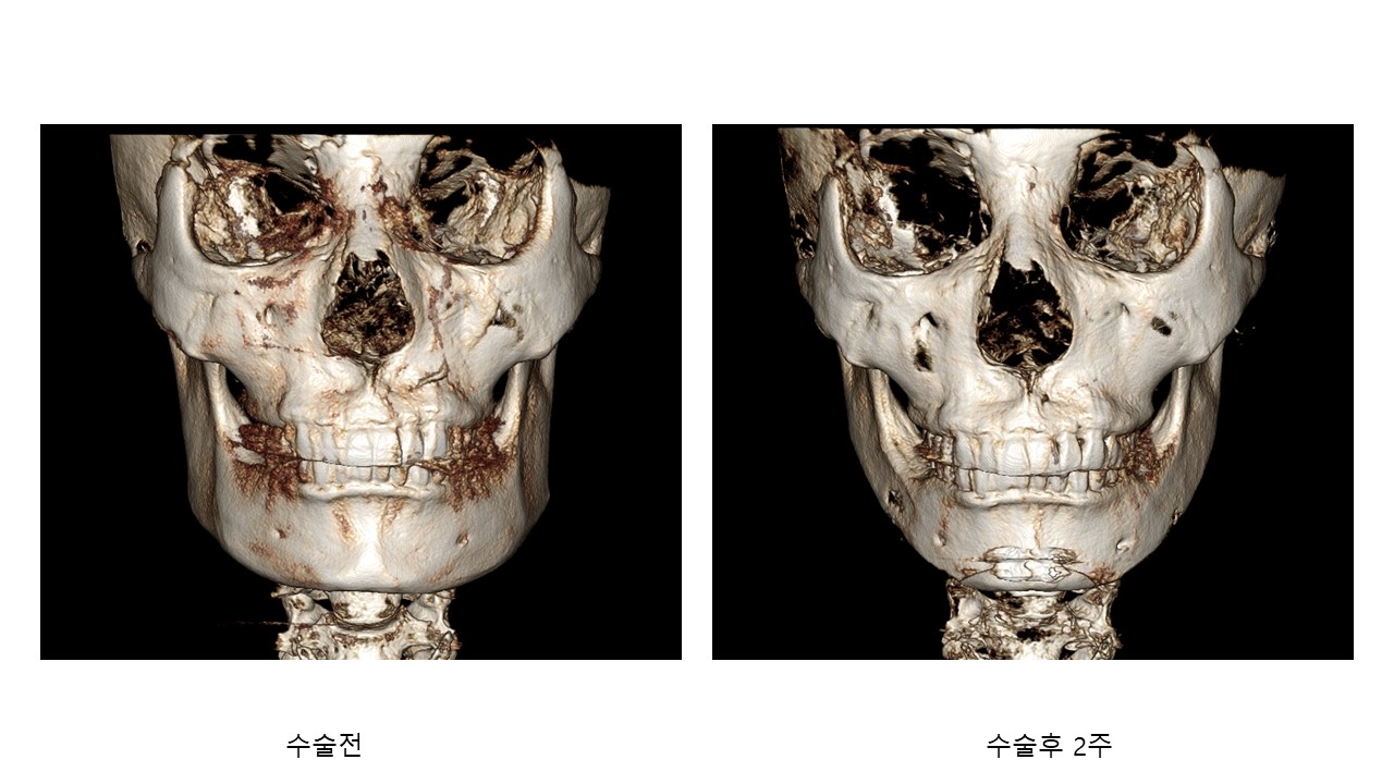 Bone Regeneration after Square Jaw Surgery 관련 이미지 5