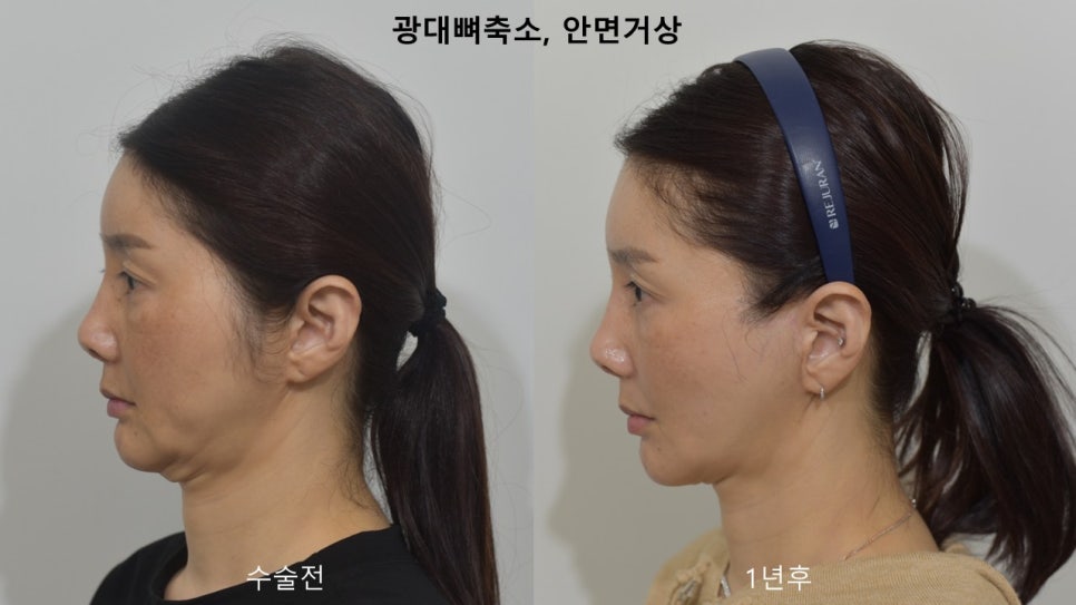"윤곽거상 수술 " 실제 사례 소개 관련 이미지 5