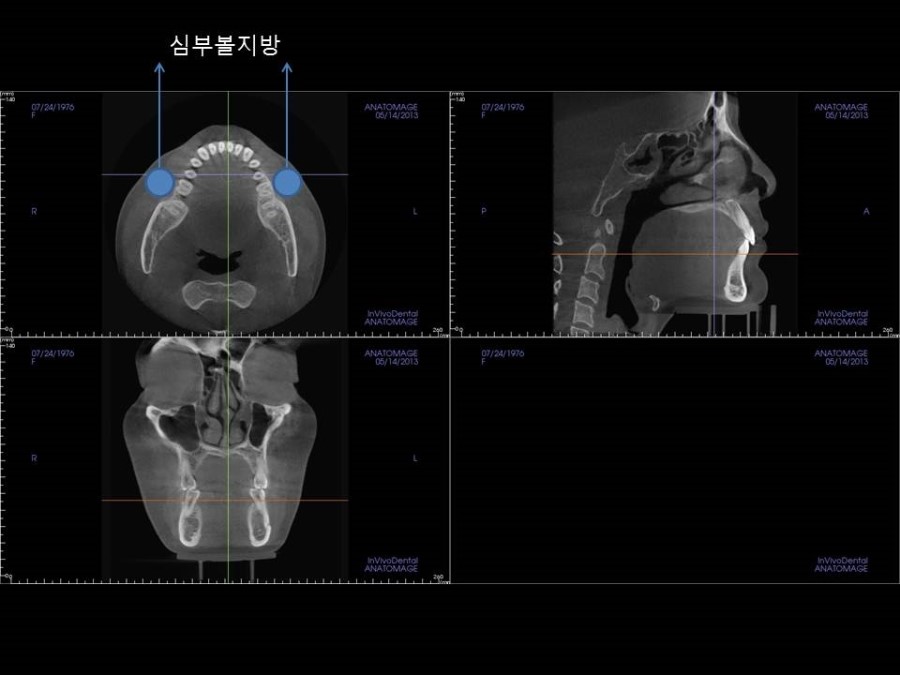 3DCT분석을 통한 심부볼지방의 위치와 심부볼지방이 얼굴윤곽에 미치는 영향 관련 이미지 3