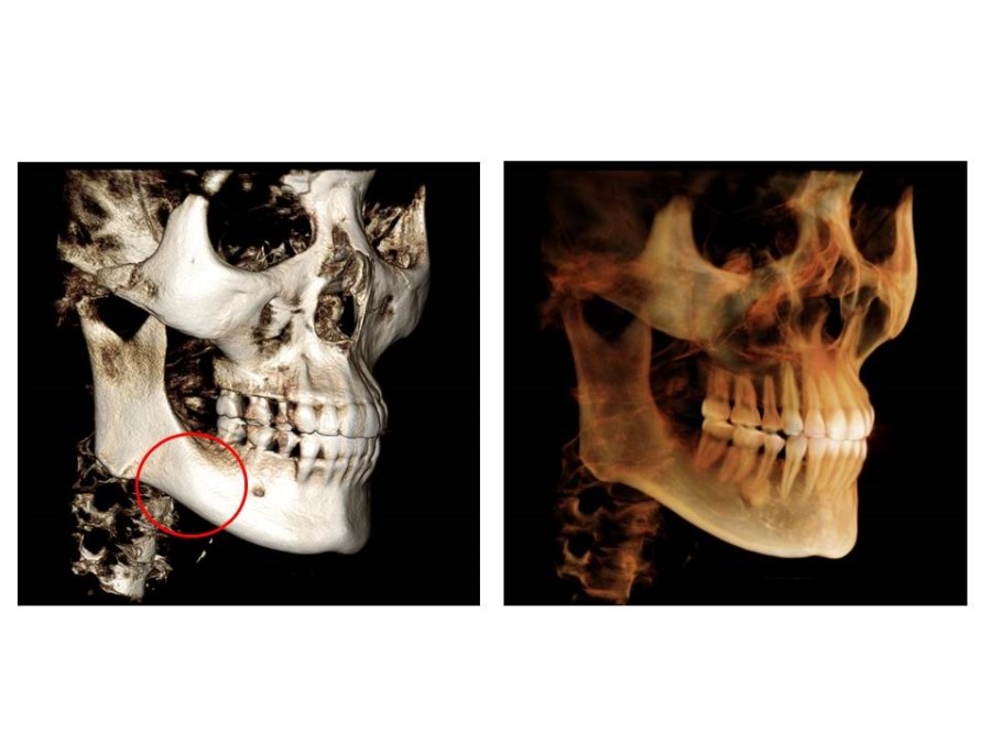 Proper Understanding of Cortical Bone Resection or Cortical Bone Reduction in Square Jaw Surgery image 3