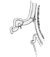 Protruding Ear Surgery image 3