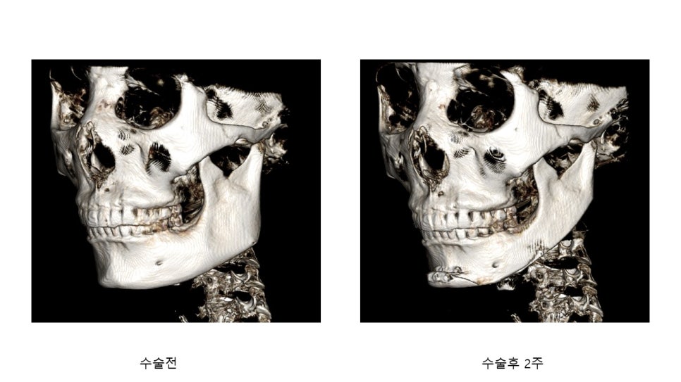 사각턱 수술후 시기에 따른 아랫턱뼈의 형태변화 관련 이미지 8