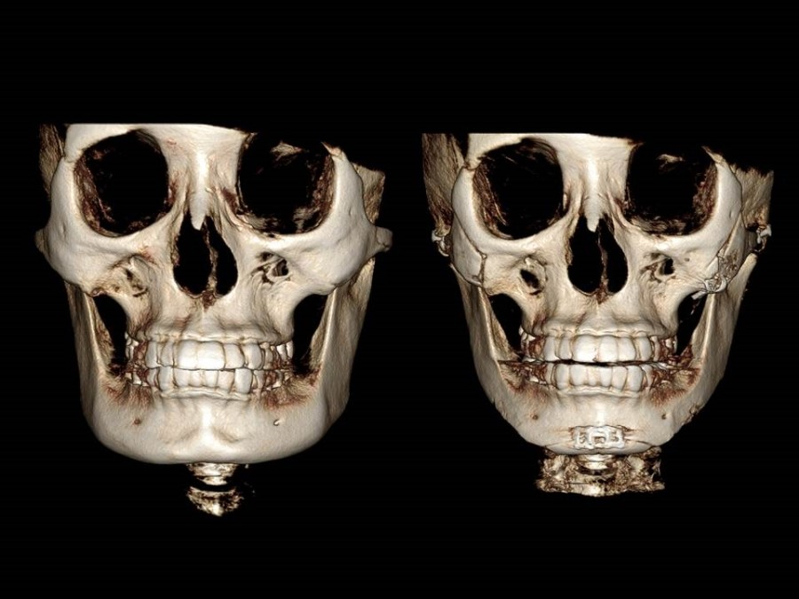V-Line Square Jaw Surgery - The Appropriate Surgical Method According to the Shape of the Chin image 16