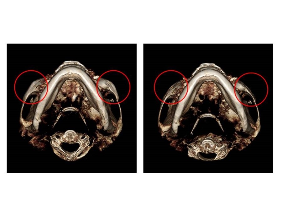 Understanding the Structure of the Cheekbone and Cheekbone Reduction Surgery image 12